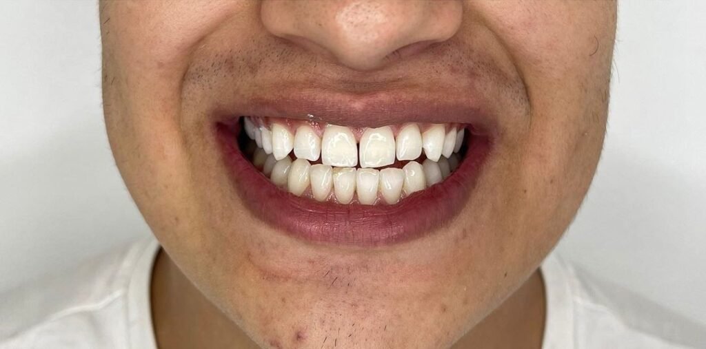 Blanqueamiento dental en Chapinero Bogotá