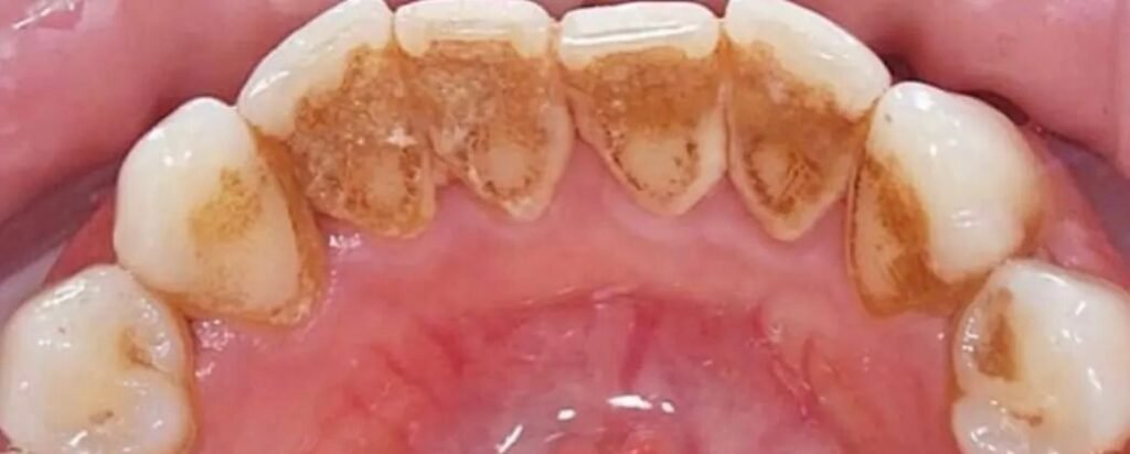 Limpieza Dental en Chapinero, Bogotá