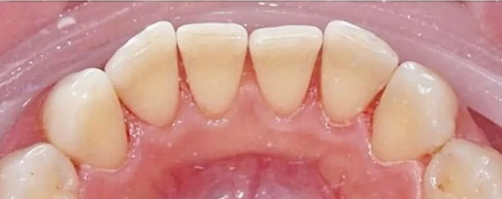 Limpieza Dental en Chapinero, Bogotá