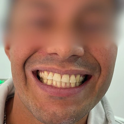 Limpieza Dental Profesional en Bogotá