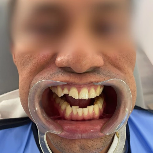 diseño de sonrisa Pereira