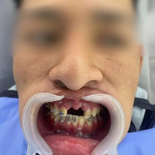 diseño de sonrisa Pereira