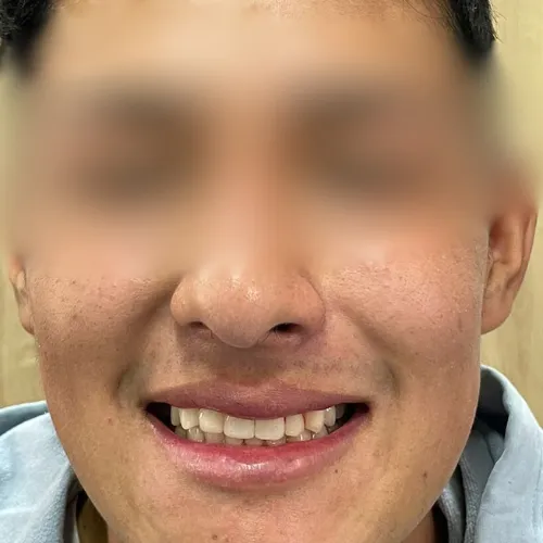 Limpieza Dental Profesional en Bogotá