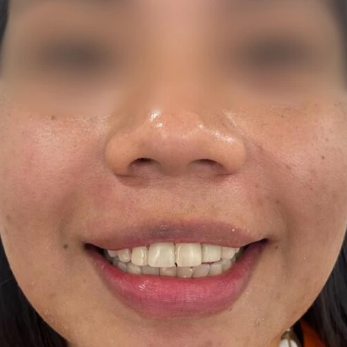 Limpieza Dental Profesional en Bogotá