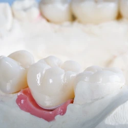 Coronas sobre Implantes en Bogotá
