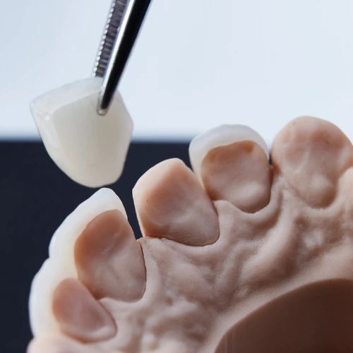 Coronas sobre Implantes en Bogotá