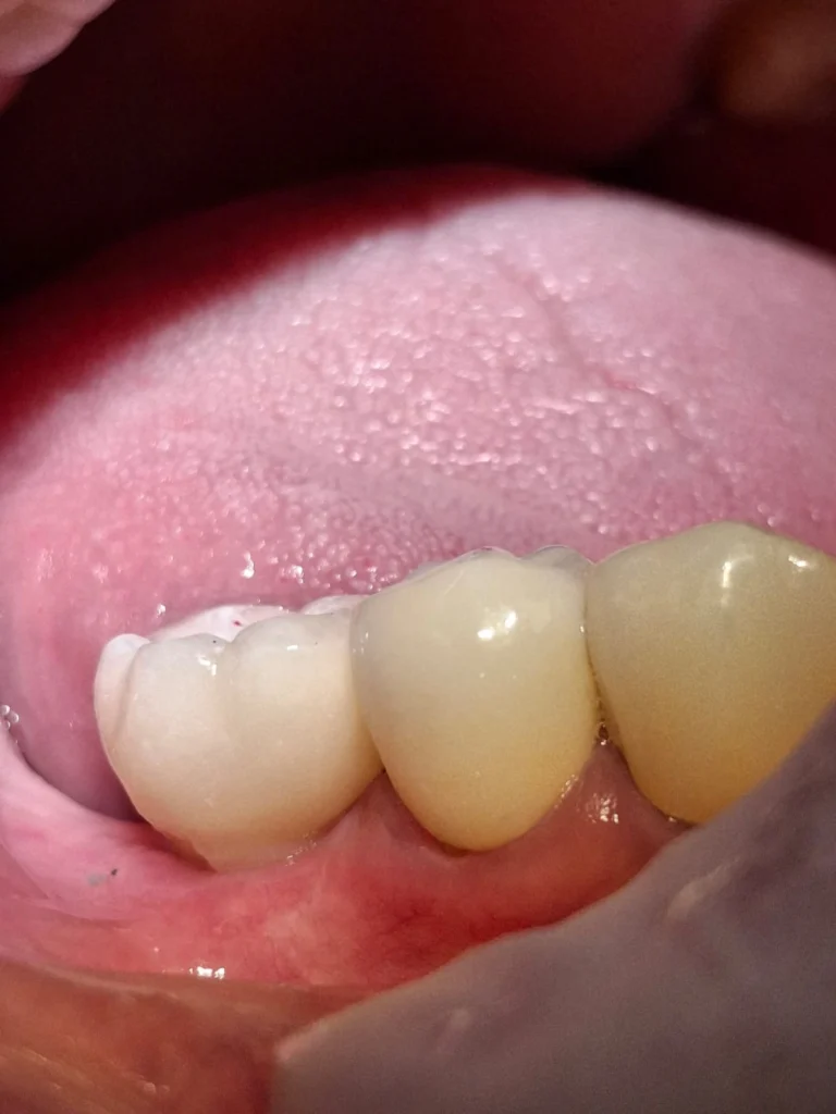 Mejores Clínicas de Implantes Dentales en Bogotá