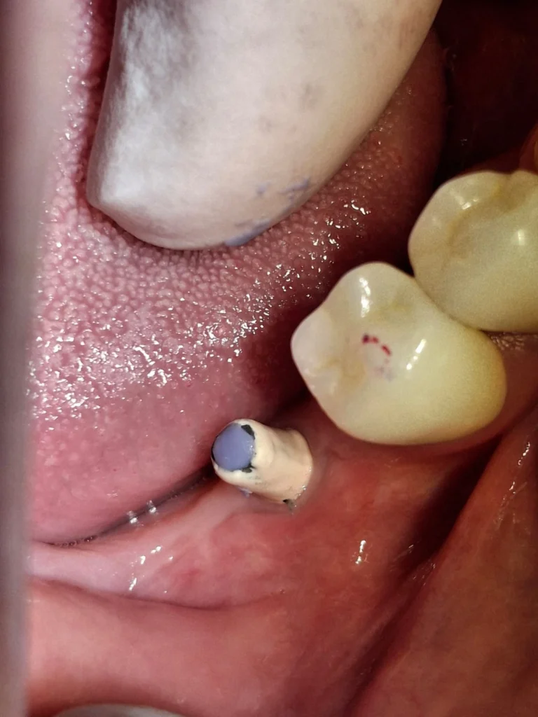 Mejores Clínicas de Implantes Dentales en Bogotá