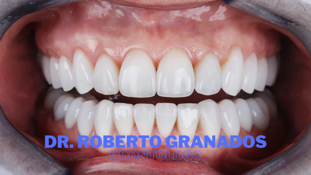 Diseño de Sonrisa Natural en Bogotá