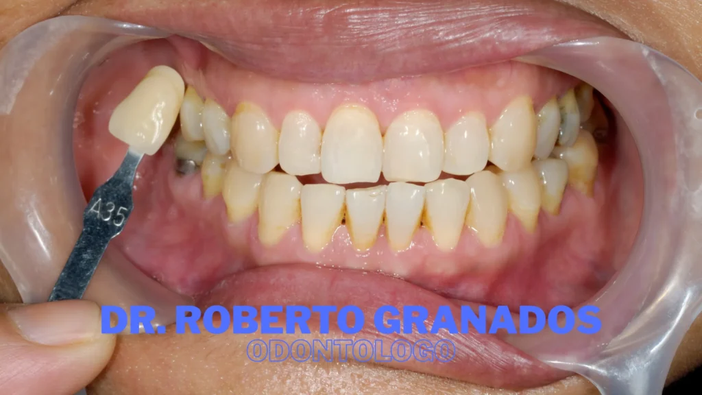 Diseño de Sonrisa en Antonio Nariño Bogotá