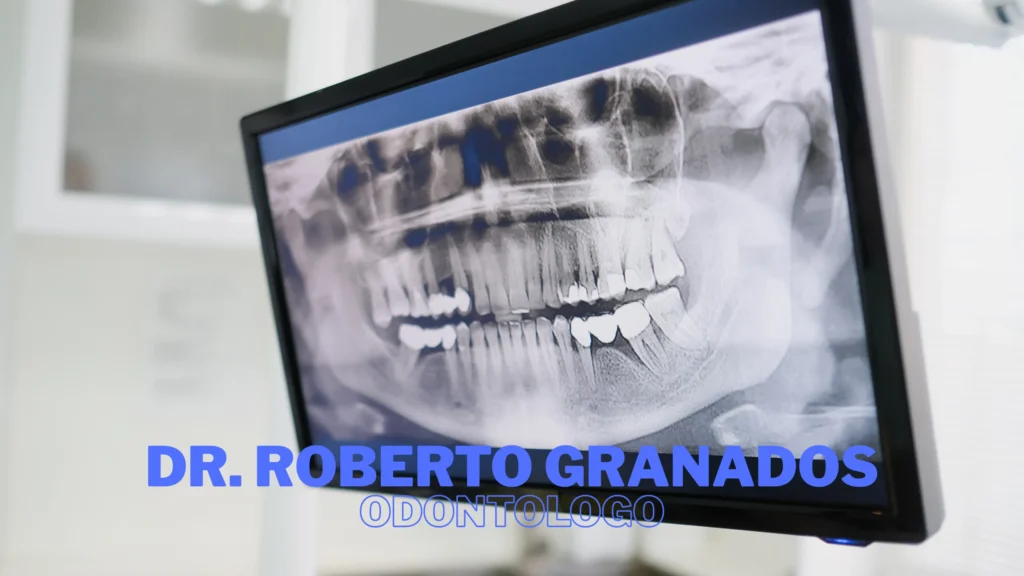 Coronas sobre Implantes en La Candelaria Bogotá