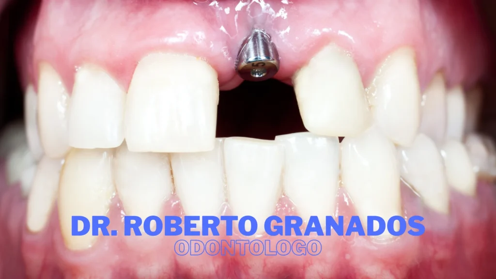 Diseño de Sonrisa en Antonio Nariño Bogotá