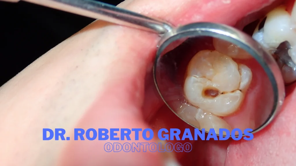Endodoncia en Chapinero, Bogotá - Dr. Roberto Granados