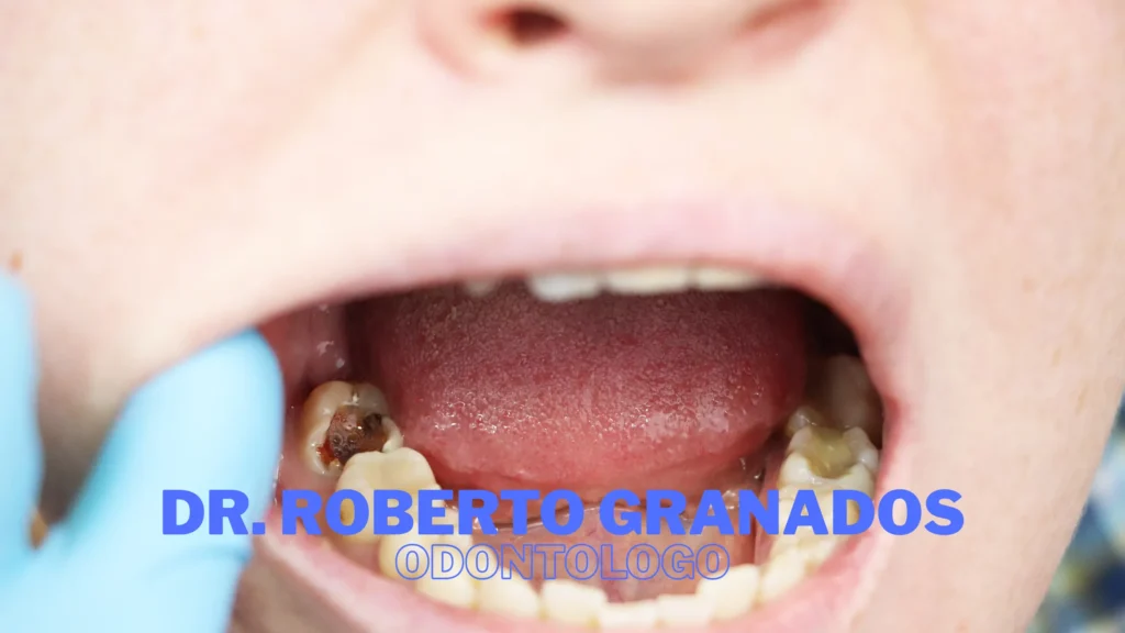 Endodoncia en Chapinero, Bogotá - Dr. Roberto Granados