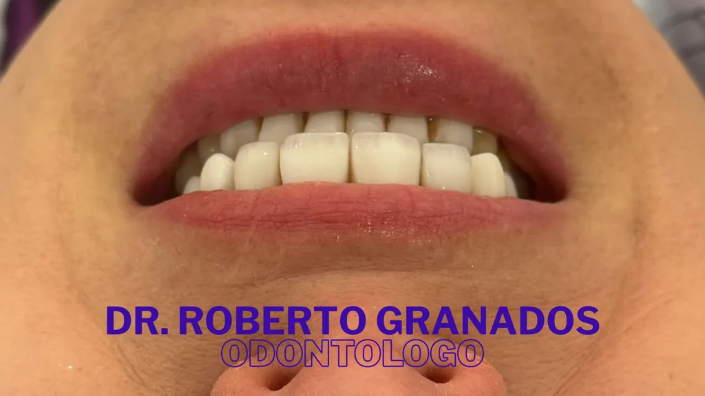 Micro diseño de sonrisa en Rincón del Chicó