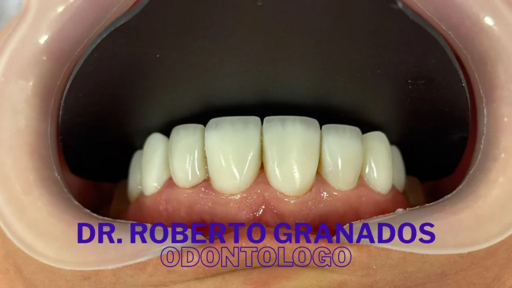 Diseño de Sonrisa Natural en Bogotá