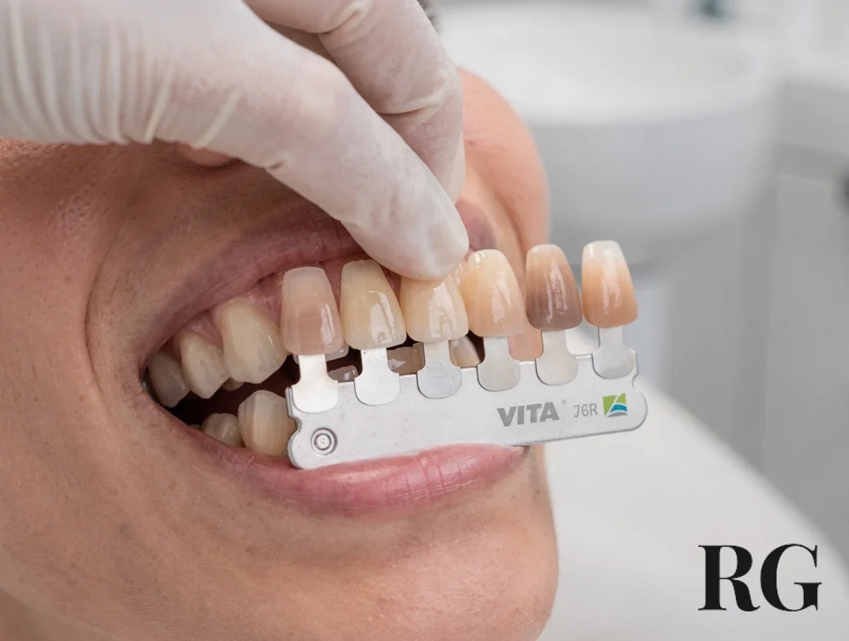 Guía de tonos dental comparada con los dientes del paciente en el consultorio